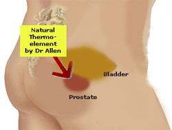 Dr. Allen’s Device for Prostate Care